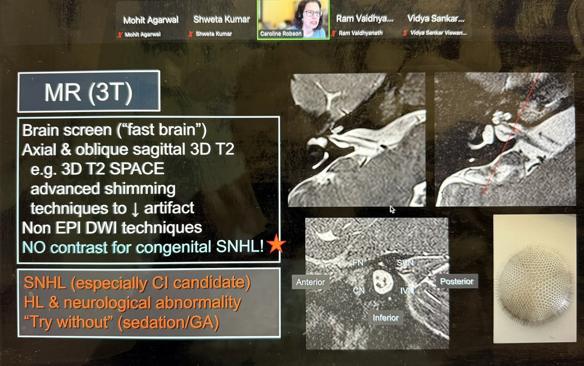 Mohit Agarwal (@mohittccneuro) on Twitter photo This webinar is now on! <a href="/callyrobs/">Caroline Robson, MBChB</a> now talking on Pediatric T bone.
You can still join bit.ly/TCCWebinarMay2ā¦
<a href="/shwicicle/">Shweta Kumar, MD</a> <a href="/vidya555sankar/">Vidya Sankar Viswanathan</a> <a href="/RamVaidhyanath/">Ram Vaidhyanath</a> <a href="/thecortexclub/">The Cortex Club</a> This webinar is now on! <a href="/callyrobs/">Caroline Robson, MBChB</a> now talking on Pediatric T bone.
You can still join bit.ly/TCCWebinarMay2ā¦
<a href="/shwicicle/">Shweta Kumar, MD</a> <a href="/vidya555sankar/">Vidya Sankar Viswanathan</a> <a href="/RamVaidhyanath/">Ram Vaidhyanath</a> <a href="/thecortexclub/">The Cortex Club</a>