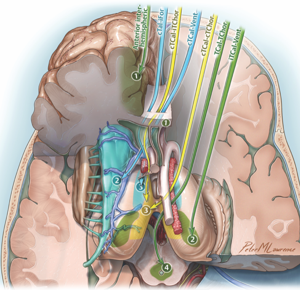 Michael T. Lawton, MD (@mtlawton) on Twitter photo Watch Seven Series video showing this bifrontal craniotomy, anterior interhemispheric approach, transcallosal-transchoroidal fissure approach, resection of interpeduncular midbrain cavernous malformation, on our website <a href="/BarrowNeuro/">BarrowNeurological</a> by clicking on this…Bar.rw/7series. Watch Seven Series video showing this bifrontal craniotomy, anterior interhemispheric approach, transcallosal-transchoroidal fissure approach, resection of interpeduncular midbrain cavernous malformation, on our website <a href="/BarrowNeuro/">BarrowNeurological</a> by clicking on this…Bar.rw/7series.