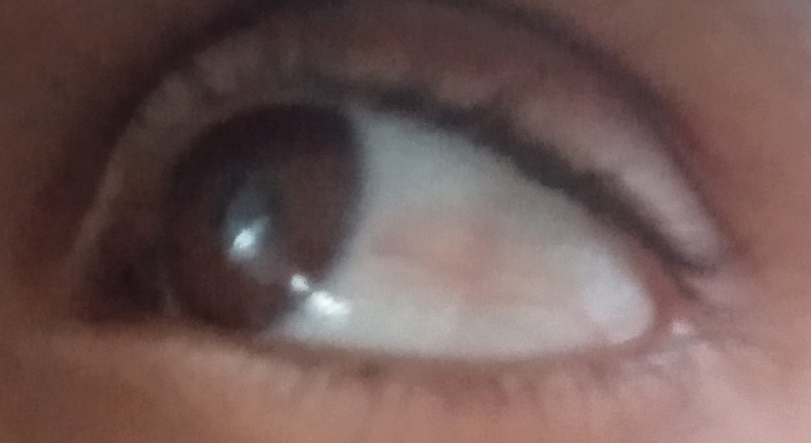 I need immediate treatment for my eye, it is hurting me. Please help me, even if it is just a small amount.chuffed.org/project/126471…