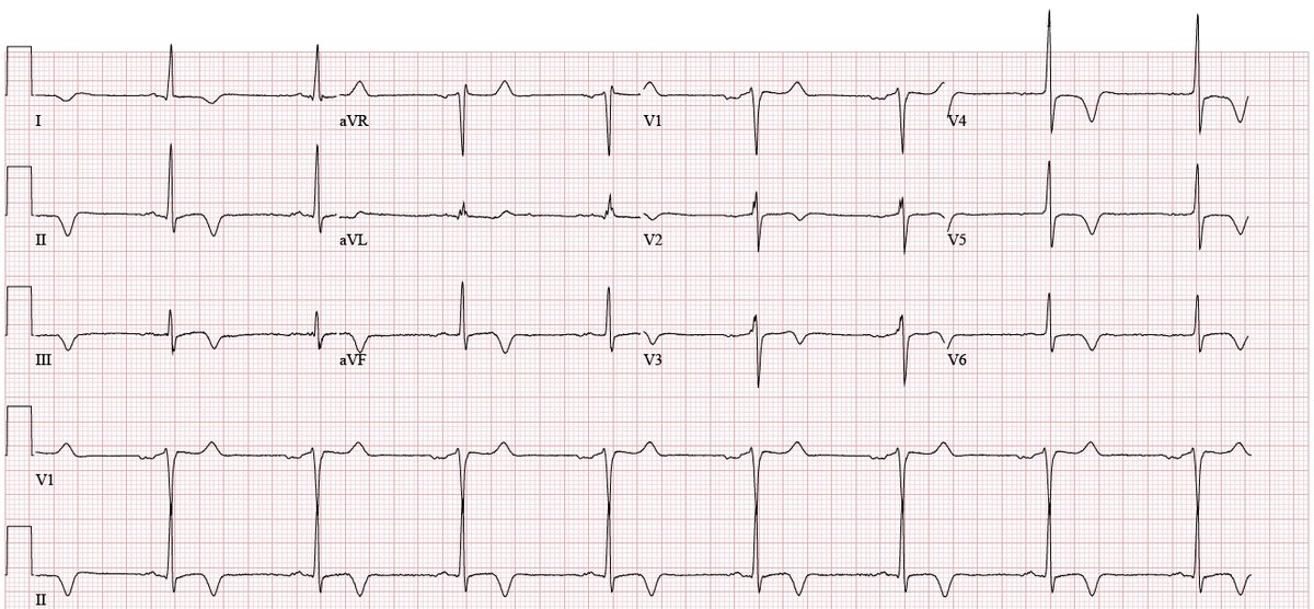 Stephen W. Smith (@smithecgblog) on Twitter photo If you saw this EKG completely isolated from clinical context, how would you interpret it?
hqmeded-ecg.blogspot.com/2025/05/if-you…
<a href="/willyhfrick/">Willy Frick</a> If you saw this EKG completely isolated from clinical context, how would you interpret it?
hqmeded-ecg.blogspot.com/2025/05/if-you…
<a href="/willyhfrick/">Willy Frick</a>