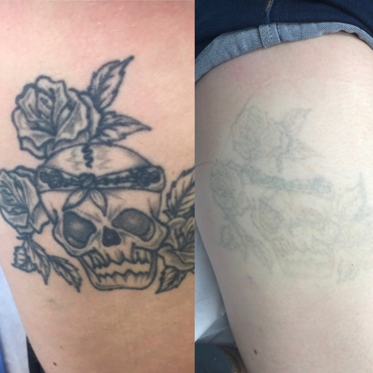original_laser's tweet photo. Just 9 laser sessions on this dark tattoo https://t.co/LkyMrydf5v