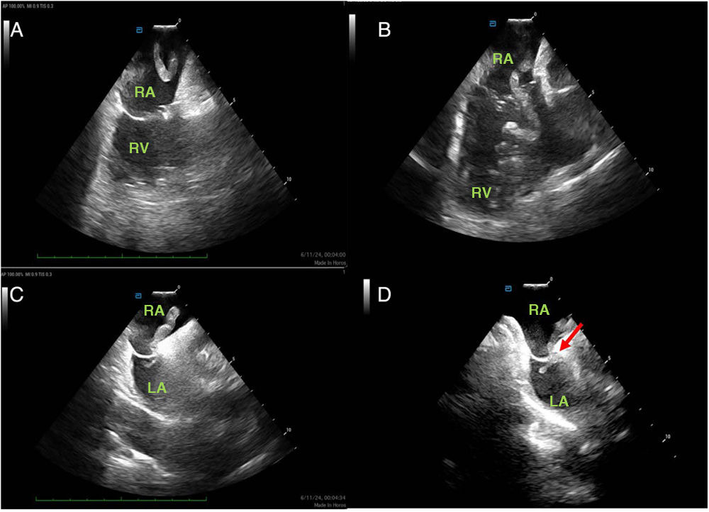 REC Publications (@revespcardiol) on Twitter photo Percutaneous thrombectomy as an urgent aspiration approach for massive pulmonary embolism in high-risk patients: a multicenter registry #REC #Aheadofprint <a href="/Sara_Blasco/">Sara Blasco Turrión</a>, <a href="/Carlos_Cortes_V/">Carlos Cortés</a>, <a href="/ignamatsant/">Ignacio J. Amat</a>
revespcardiol.org/en-percutaneou… Percutaneous thrombectomy as an urgent aspiration approach for massive pulmonary embolism in high-risk patients: a multicenter registry #REC #Aheadofprint <a href="/Sara_Blasco/">Sara Blasco Turrión</a>, <a href="/Carlos_Cortes_V/">Carlos Cortés</a>, <a href="/ignamatsant/">Ignacio J. Amat</a>
revespcardiol.org/en-percutaneou…