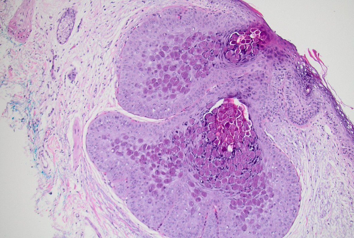 Amna Qureshi (@dr_amnaq) on Twitter photo Another beautiful case! This is biopsy of skin of the nose! Patient presented with a bump! Any guesses??? <a href="/UMichPath/">Michigan Pathology</a> <a href="/smlungpathguy/">Sanjay Mukhopadhyay</a> <a href="/pathpedia/">Pathology</a> <a href="/PATHtweets/">PATH</a> Another beautiful case! This is biopsy of skin of the nose! Patient presented with a bump! Any guesses??? <a href="/UMichPath/">Michigan Pathology</a> <a href="/smlungpathguy/">Sanjay Mukhopadhyay</a> <a href="/pathpedia/">Pathology</a> <a href="/PATHtweets/">PATH</a>