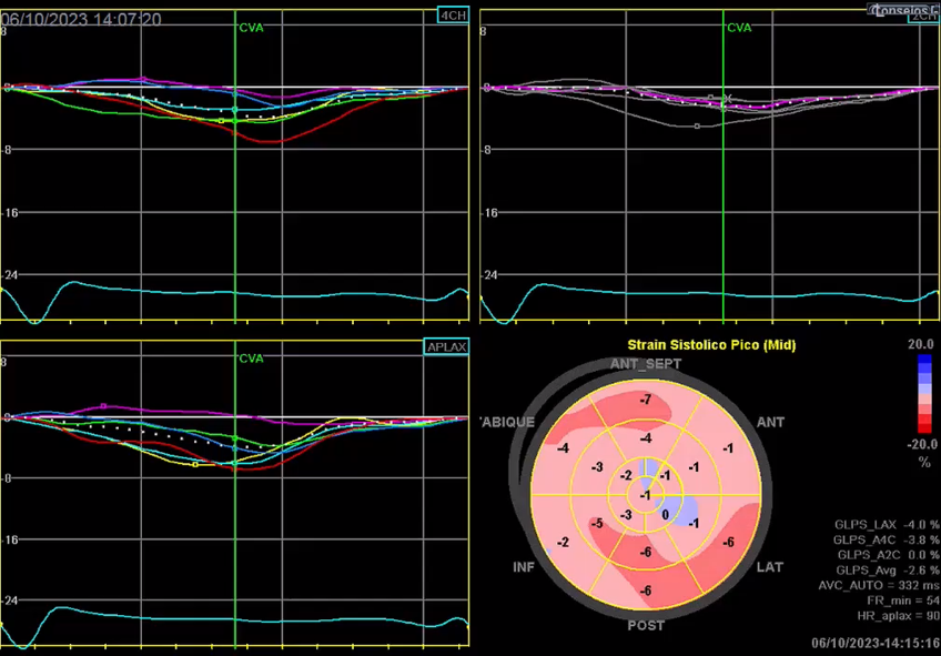 CardioCaribeMx's tweet photo. MIOcardiopatía dilatada en ecocardiograma

Dilatación ventricular y función disminuida

#ecofirst #FEVI https://t.co/4MtJOvdpkk