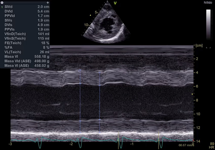 CardioCaribeMx's tweet photo. MIOcardiopatía dilatada en ecocardiograma

Dilatación ventricular y función disminuida

#ecofirst #FEVI https://t.co/4MtJOvdpkk