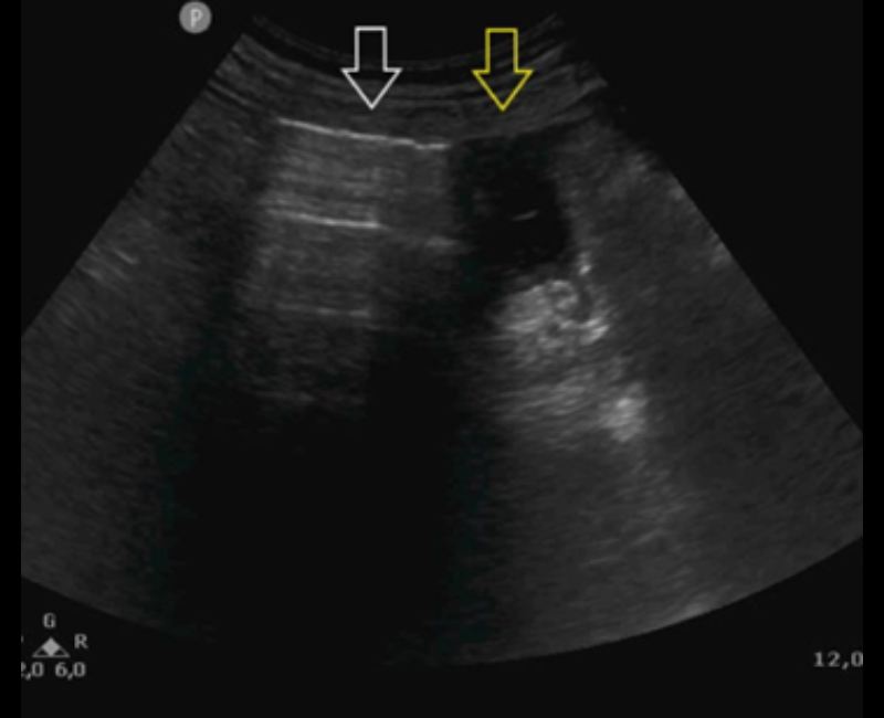 ASA (@asasonography) on Twitter photo đ This Sonography case demonstrates how âabdominal hydropointâ POCUS sign was used to identify a pneumoperitoneum in an ICU patient. #SupportingSonographers <a href="/WileyHealth/">Wiley Clinical Health</a>
loom.ly/OWdZQuY đ This Sonography case demonstrates how âabdominal hydropointâ POCUS sign was used to identify a pneumoperitoneum in an ICU patient. #SupportingSonographers <a href="/WileyHealth/">Wiley Clinical Health</a>
loom.ly/OWdZQuY