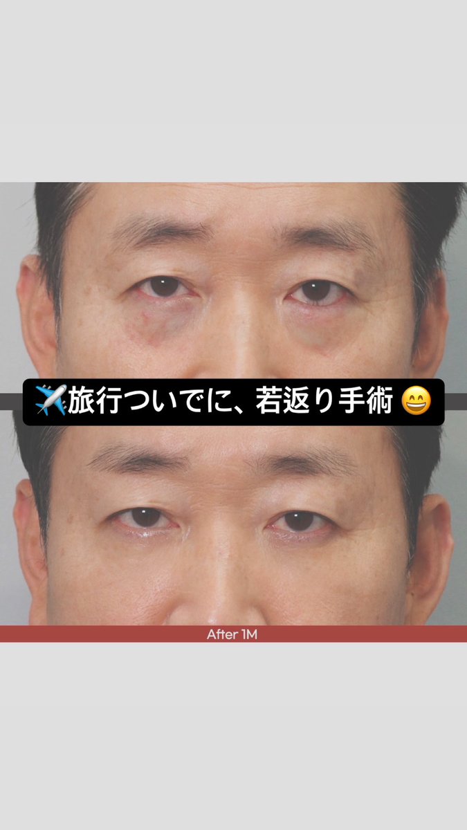 lemiel_jp's tweet photo. ✈️韓国旅行のついでに、お父さんへ目元のアンチエイジングをプレゼントしませんか？🎁💐

ルミエルのアンコール目の下脂肪再配置は、
当日施術OK、腫れや内出血などのダウンタイムもほとんどありません😆

旅行中も楽しめて、1週間毎日LINEで経過管理❣️
帰国後も安心です😊 https://t.co/BATrTJHYIS