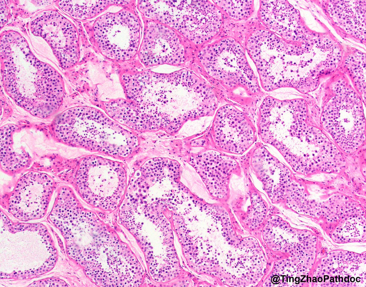 Ting Zhao, MD (@tingzhaopathdoc) on Twitter photo 16 y.o. M, orchiectomy. What is your diagnosis? The gross photo is in the chat.
#PathTwitter
<a href="/MGBpathology/">Mass General Brigham Pathology</a> <a href="/MGHPathology/">MGH Pathology</a> 16 y.o. M, orchiectomy. What is your diagnosis? The gross photo is in the chat.
#PathTwitter
<a href="/MGBpathology/">Mass General Brigham Pathology</a> <a href="/MGHPathology/">MGH Pathology</a>