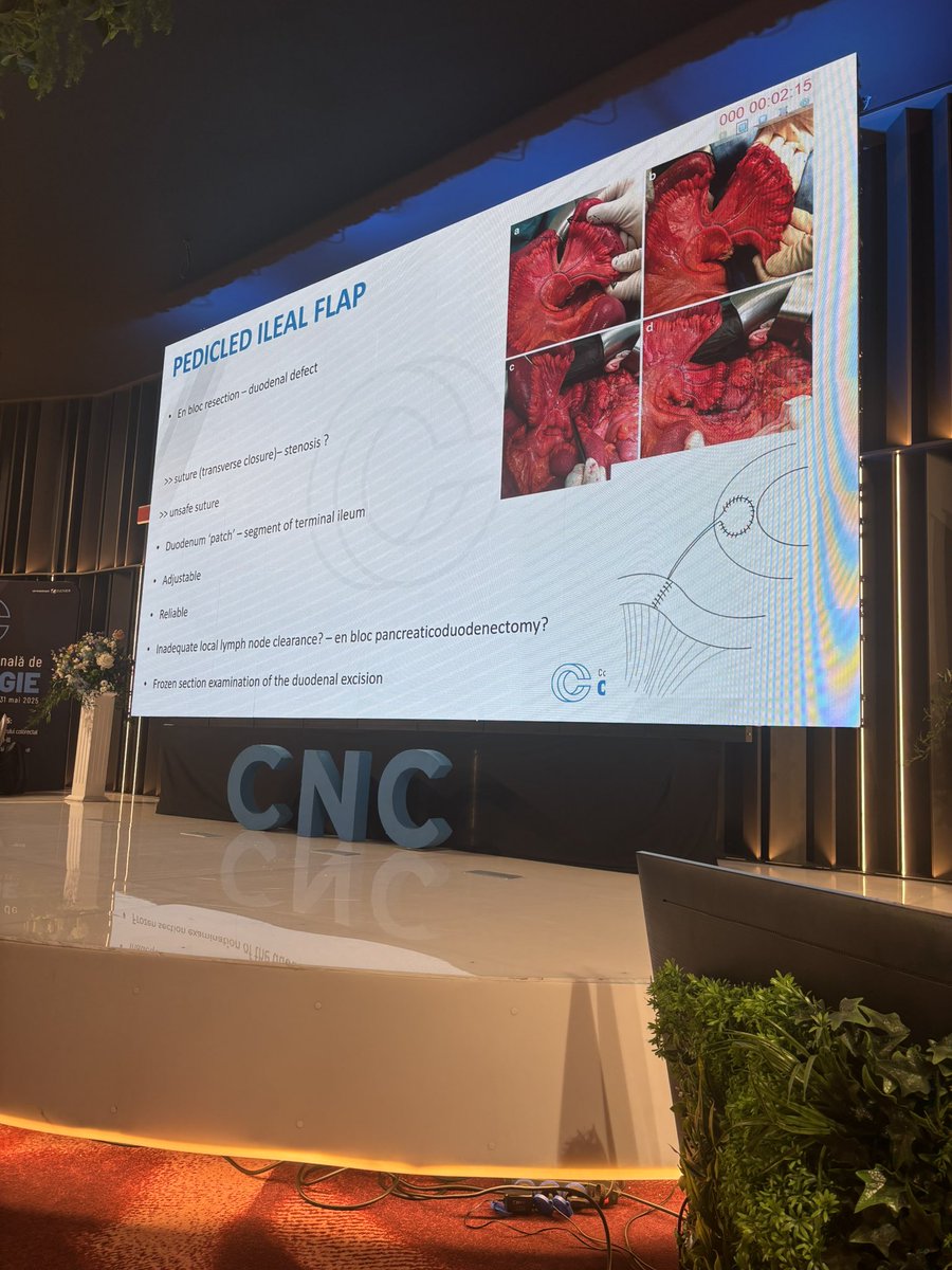 Miguel F. Cunha (@miguelcunhasurg) on Twitter photo Thank you 🇷🇴 for the kind invitation to the Romanian National Conference!
An honour to speak on EOCRC: surgical implications & patient perspective 💬
Superb science, amazing hosts!
Big thanks to prof. Viorel Scripcariu 👏
#EOCRC #ColorectalSurgery
<a href="/DrErmanAytac/">ErmanAytac</a> Thank you 🇷🇴 for the kind invitation to the Romanian National Conference!
An honour to speak on EOCRC: surgical implications & patient perspective 💬
Superb science, amazing hosts!
Big thanks to prof. Viorel Scripcariu 👏
#EOCRC #ColorectalSurgery
<a href="/DrErmanAytac/">ErmanAytac</a>