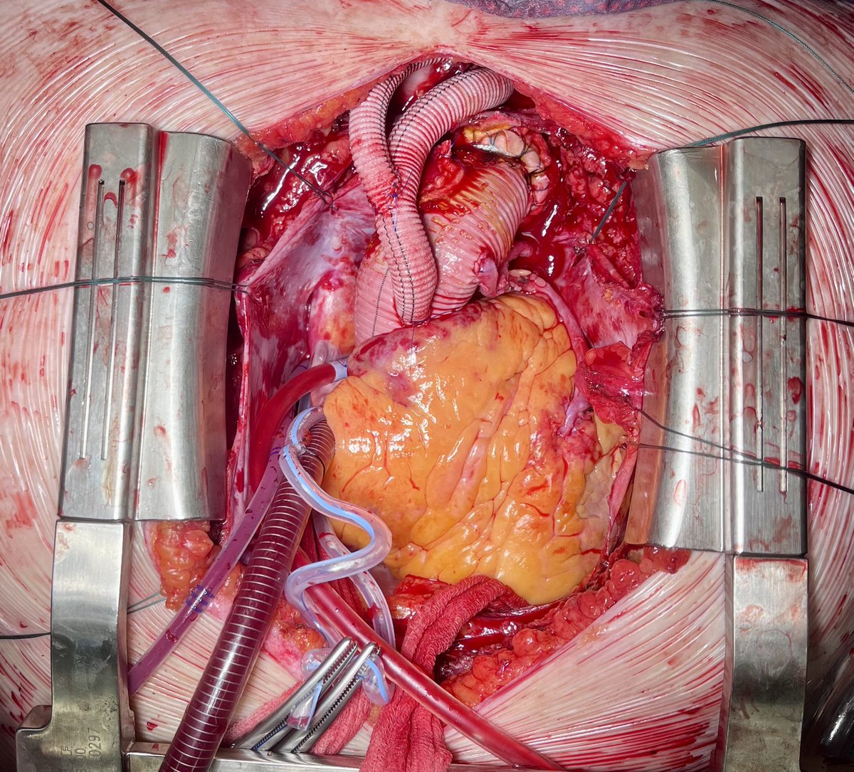 🔺 Complex cardiac surgery in Harburg: FET + reimplantation of the brachiocephalic trunk, common carotid arteries, and distal anastomosis to the left subclavian artery + 2× CABG. #CardiacSurgery #FET #CABG @AortaHarburg