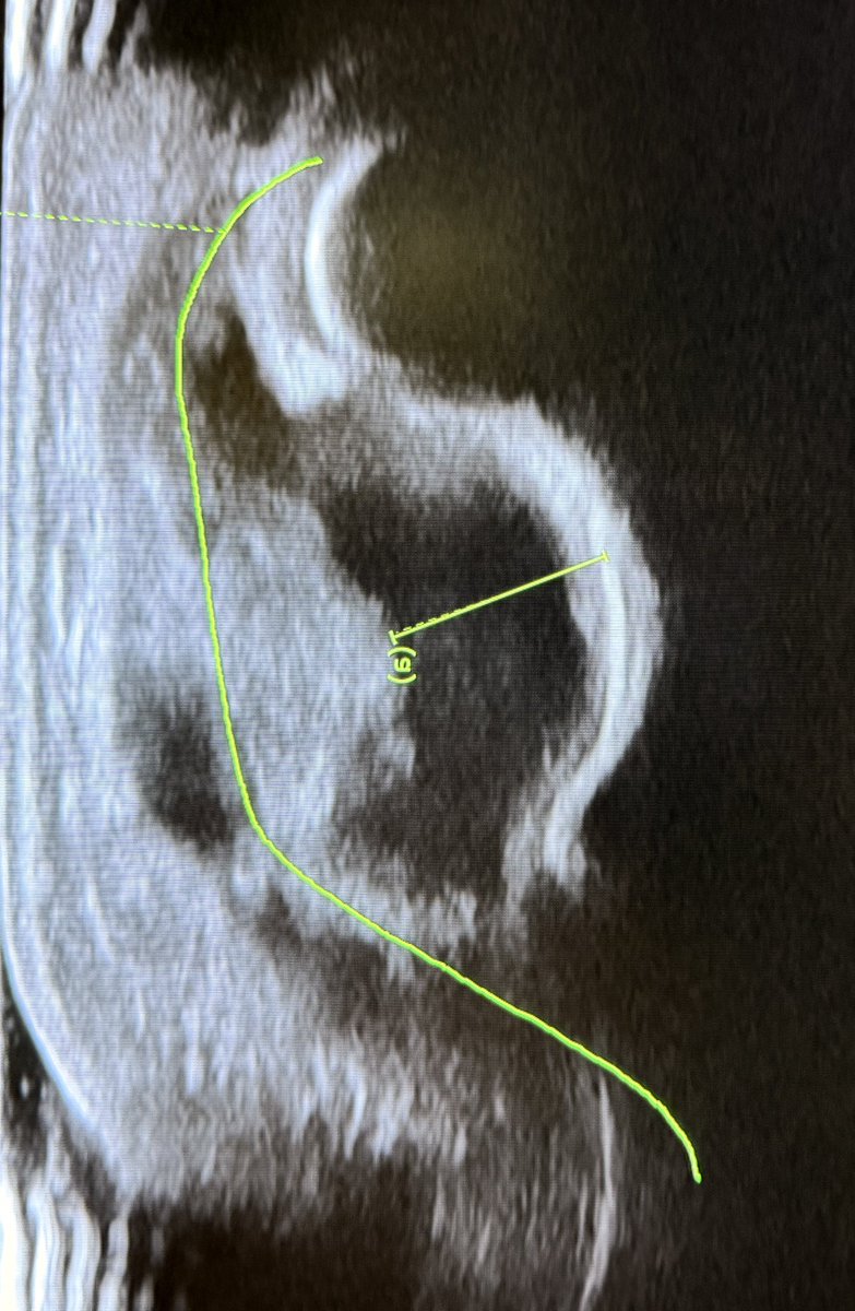 Nothing fancy today! 

This is just a classic case with an elevated posterior fat pad (also called the “posterior fat pad sign”) on an elbow X-ray, with an ultrasound to back it up.

—Classic signs in radiology from my reporting list
