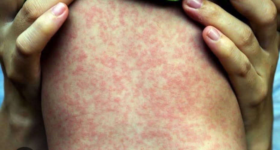 Улаан бурханы вакцин бол Монгол улсад 1973 оноос  хойш 50 гаруй жил амжилттай хийгээд явж бсан товлолт вакцин. 
Гэвч вакцин эсэргүйцэгч нарын муйхар ятгалгын үр дүнд хүүхдүүддээ вакцинд хамруулаагүйгээс  болж олон хүүхдүүд улаан бурхан өвчнөөр өвдөж бас нас барж бна. 
Вакцин