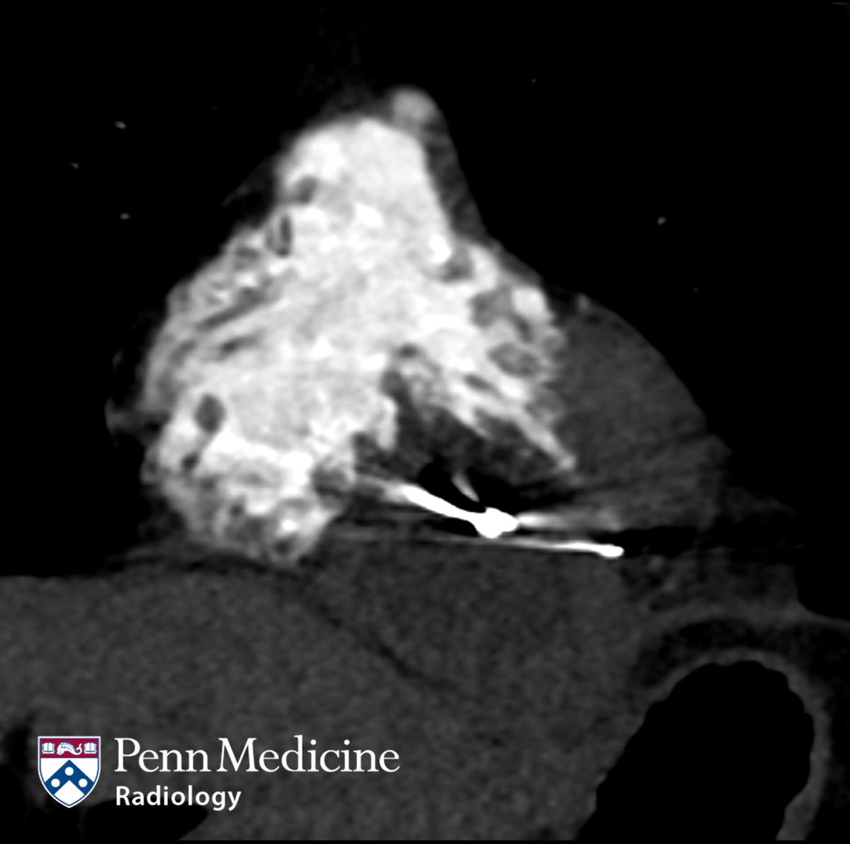AuntMinnie.com (@auntminnie) on Twitter photo How would you diagnose this case? 51-year-old man with ICD and worsening chest pain #radiology <a href="/PennMedicine/">Penn Medicine</a> buff.ly/MKiWVtJ How would you diagnose this case? 51-year-old man with ICD and worsening chest pain #radiology <a href="/PennMedicine/">Penn Medicine</a> buff.ly/MKiWVtJ