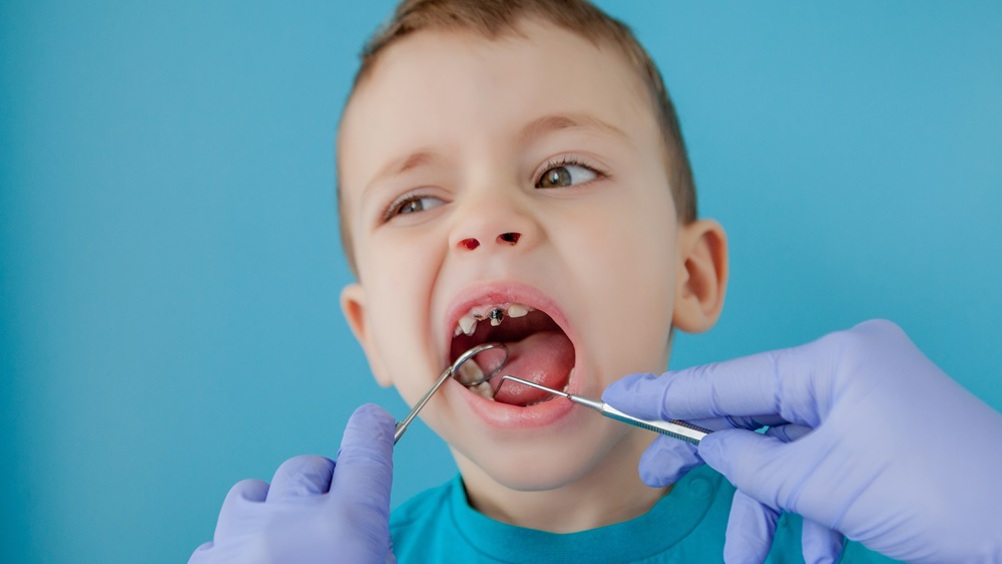 TheDentistMag (@thedentistmag) on Twitter photo The latest analysis from <a href="/NuffieldTrust/">Nuffield Trust</a> has revealed that five-year-olds in London and northern England experience the worst rates of dental decay.
Find out more here:
➡️ ow.ly/qj4h50W1AKU
#toothdecay #decay #oralhealth #children #dentalhealth #deprivation #dentistry The latest analysis from <a href="/NuffieldTrust/">Nuffield Trust</a> has revealed that five-year-olds in London and northern England experience the worst rates of dental decay.
Find out more here:
➡️ ow.ly/qj4h50W1AKU
#toothdecay #decay #oralhealth #children #dentalhealth #deprivation #dentistry