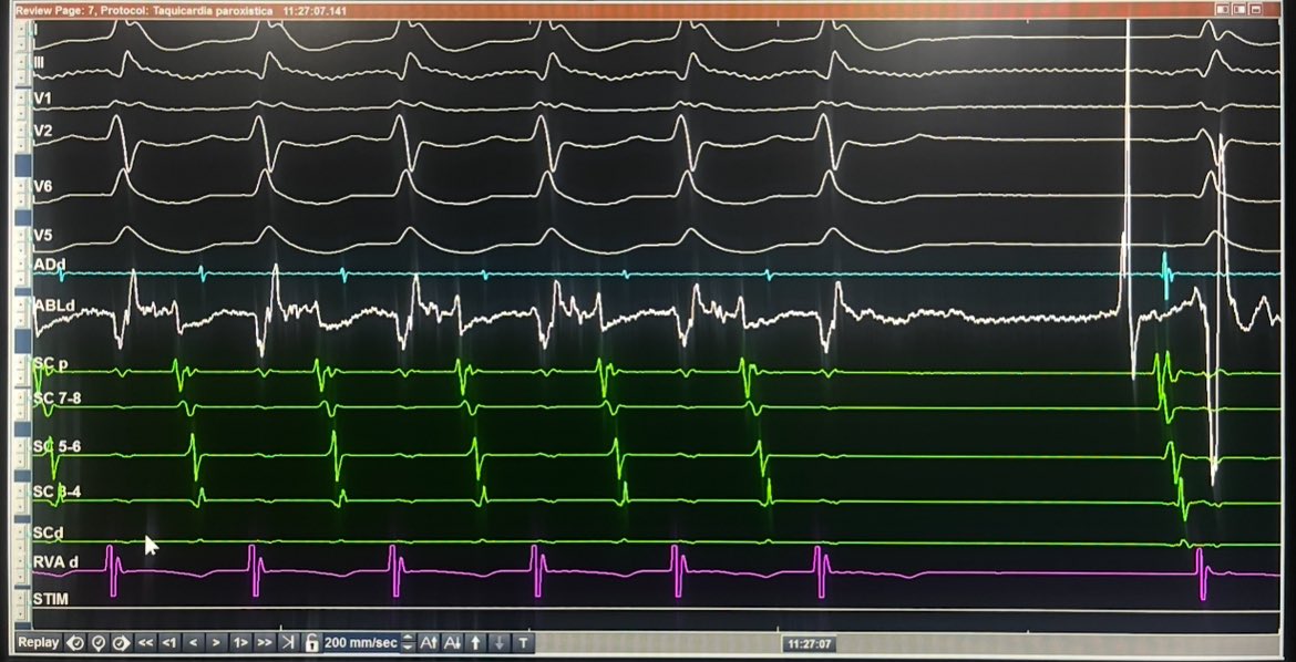 8 yof patient. 
Manifest right posterior AP
SVT since she was born.
s/p unsuccessful  prior RFA in other center

“Kent potential showed us where to burn”

Beautiful ECG depicting ORT termination and first beat of this child without delta wave in her life.

<a href="/hospitalposadas/">Hospital Posadas</a>