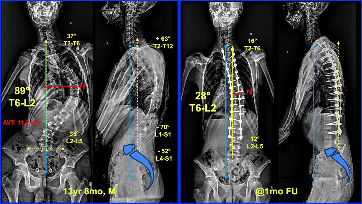SakuraOrtospine's tweet photo. Marfan syndrome is a connective tissue disorder that significantly impacts the musculoskeletal system, particularly the spine. 
#scoliosis #marfan #kyphosis #spondylolisthesis https://t.co/ouPCMpJs2t