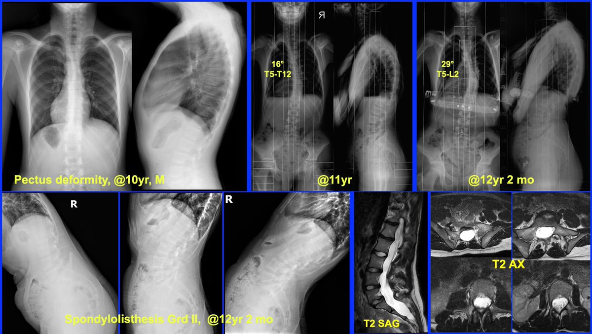 Marfan syndrome is a connective tissue disorder that significantly impacts the musculoskeletal system, particularly the spine. 
#scoliosis #marfan #kyphosis #spondylolisthesis