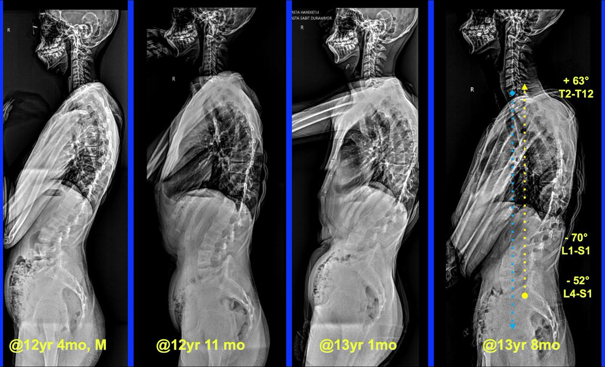 SakuraOrtospine's tweet photo. Marfan syndrome is a connective tissue disorder that significantly impacts the musculoskeletal system, particularly the spine. 
#scoliosis #marfan #kyphosis #spondylolisthesis https://t.co/ouPCMpJs2t