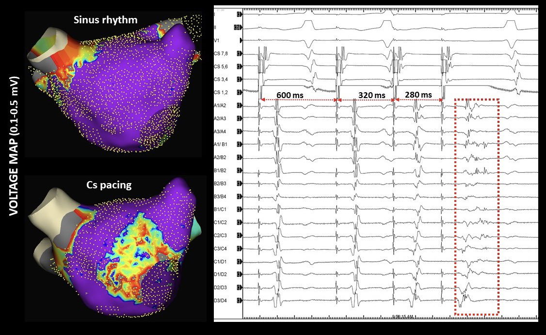 Hikmet Yorgun (@hikmetyorgun) on Twitter photo Do you always rely on sinus rhythm voltage during atrial mapping?
👇
Change in atrial voltage maps during Cs pacing compared to sinus rhythm in a re-do procedure after PVI. Decremental pacing clearly elucidates functional substrate.
pubmed.ncbi.nlm.nih.gov/40391692/
#EPeeps <a href="/pace_journal/">Pacing and Clinical Electrophysiology</a> Do you always rely on sinus rhythm voltage during atrial mapping?
👇
Change in atrial voltage maps during Cs pacing compared to sinus rhythm in a re-do procedure after PVI. Decremental pacing clearly elucidates functional substrate.
pubmed.ncbi.nlm.nih.gov/40391692/
#EPeeps <a href="/pace_journal/">Pacing and Clinical Electrophysiology</a>