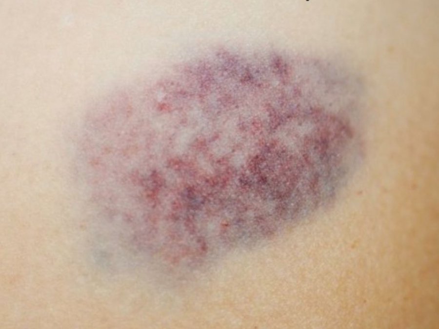 تصحى من نومك احيانا تلقى البقعة هذه ظهرت فجأة وما تعرف وش السبب أو مدى خطورتها ؟ 

  لنتعرف على هذا الشيء..

بشرح لكم بالتفصيل أسفل التغريدة🧵