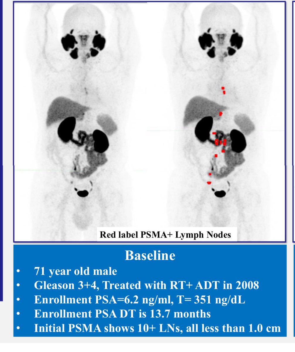 Ravi A Madan M.D. (@dr_ravimadan) on Twitter photo Updated data from #PSMA monitoring study in #BCR #ProstateCancer <a href="/ASCO/">ASCO</a> #ASCO25
Stop by & see our poster on Monday morning
You can see what happens to this pt at 6 months 10+ LNs
How would you have managed this case?
Trial continues to accrue <a href="/theNCI/">National Cancer Institute</a>
clinicaltrials.gov/study/NCT05588… Updated data from #PSMA monitoring study in #BCR #ProstateCancer <a href="/ASCO/">ASCO</a> #ASCO25
Stop by & see our poster on Monday morning
You can see what happens to this pt at 6 months 10+ LNs
How would you have managed this case?
Trial continues to accrue <a href="/theNCI/">National Cancer Institute</a>
clinicaltrials.gov/study/NCT05588…