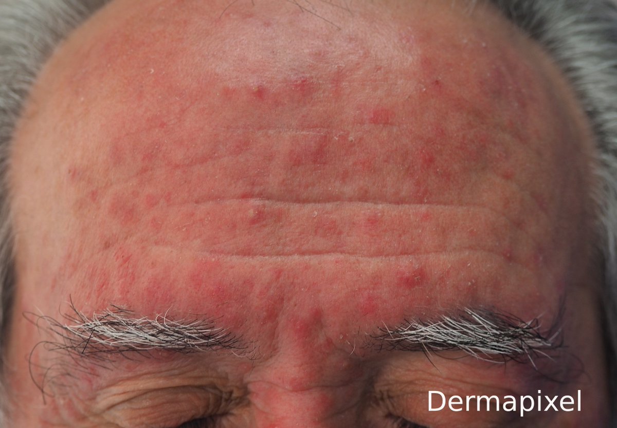 Rosa Taberner (@rosataberner) on Twitter photo Vosotros, ¿qué opináis? ¿Granos o alergia?
El caso de <a href="/dermapixel/">Dermapixel</a> de esta semana
dermapixel.com/2025/05/granos…
#dermatología #pasenyvean Vosotros, ¿qué opináis? ¿Granos o alergia?
El caso de <a href="/dermapixel/">Dermapixel</a> de esta semana
dermapixel.com/2025/05/granos…
#dermatología #pasenyvean