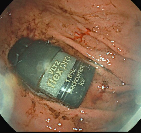 Srisha_Hebbar's tweet image. FB (wide diameter) removal. Gastric overtube, made 2 x slits at the lower end. FB was captured with snare & negotiated partly into the lips of the slit overtube. With a constant pressure on the catheter, overtube with FB was pulled out. What's your technique ? #GItwitter