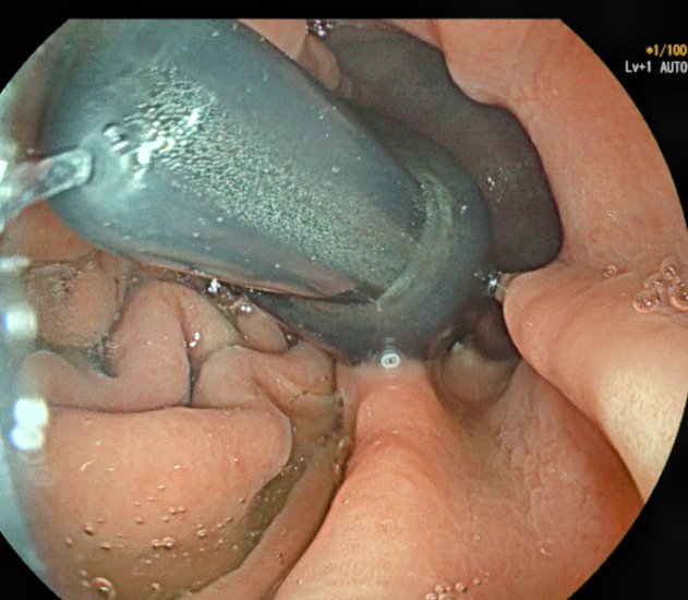 Srisha_Hebbar's tweet image. FB (wide diameter) removal. Gastric overtube, made 2 x slits at the lower end. FB was captured with snare & negotiated partly into the lips of the slit overtube. With a constant pressure on the catheter, overtube with FB was pulled out. What's your technique ? #GItwitter