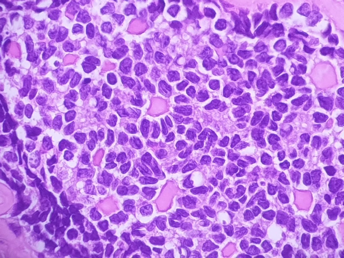 Incidental tiny nodule (less than 0,5 mm) in the wall of an endometriosis cyst in a pregnant woman #gynpath #pathtwitter

Granulosa cell proliferation of pregnancy?