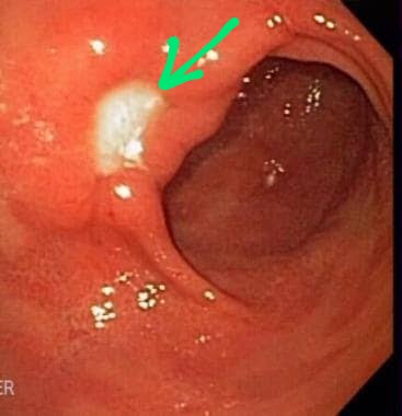 the_beardedsina's tweet photo. This is what an Ulcer looks like on Endoscopy. An Ulcer is a wound/injury 

The Red colour is the inside of the stomach.

The green arrow points to the Ulcer.( whitish) https://t.co/ddRloGH4Xz