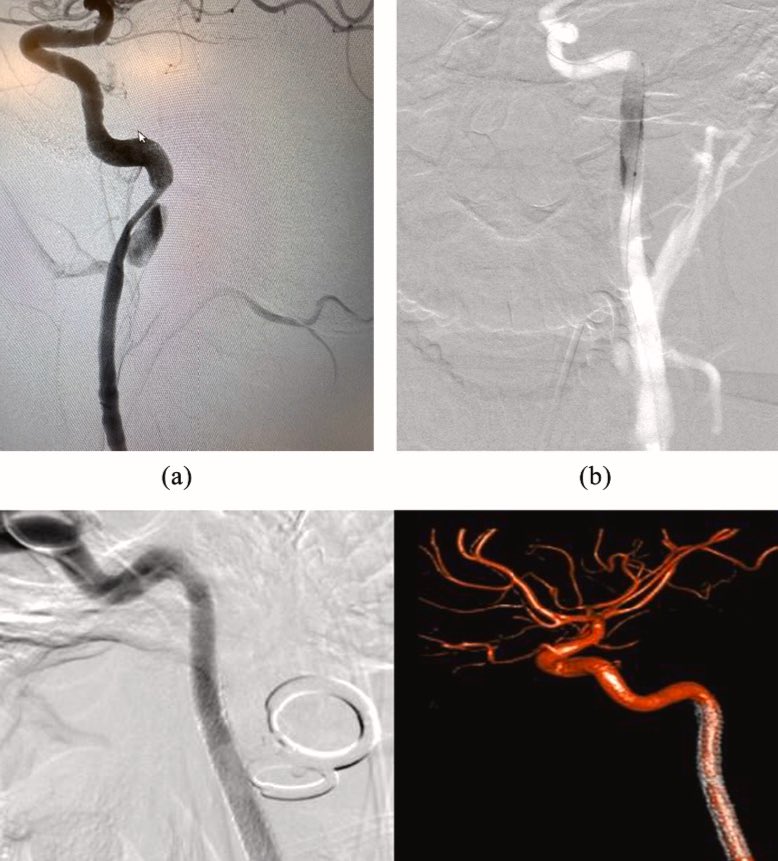 Great work by team in publication of our outcomes novel stent treat aneurysms / fistulas. Predominantly traumatic aneurysms / aneurysms treated elsewhere that continued to expand / bleed. No complications, and on follow up imaging all aneurysms or malformations remained occluded.
