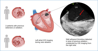HeartRhythm (@hrs_journal) on Twitter photo Intracardiac echocardiography inside left atrium detects wall-adherent thrombus before ablation and prevents potential major thromboembolic complication
<a href="/adrian_petzl/">Adrian Petzl</a> <a href="/DrFerminGarcia/">Fermin Carlos Garcia</a>
heartrhythmjournal.com/article/S1547-… Intracardiac echocardiography inside left atrium detects wall-adherent thrombus before ablation and prevents potential major thromboembolic complication
<a href="/adrian_petzl/">Adrian Petzl</a> <a href="/DrFerminGarcia/">Fermin Carlos Garcia</a>
heartrhythmjournal.com/article/S1547-…