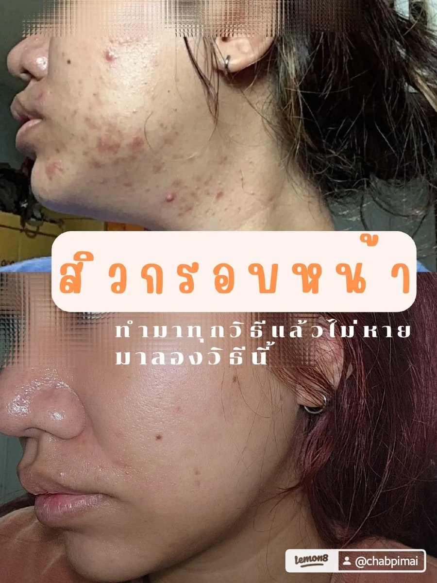 chabpimai98's tweet photo. ใครที่รักษาสิวที่กรอบหน้ามาทุกวิธี แล้วไม่หาย
สิวขึ้นที่กรอบหน้าซ้ำๆ ที่เดิม
อยากให้ลองวิธีนี้
 คือ กินพรีไบโอติก❤️❤️
 กินไปแค่อาทิตย์เดียวก็สิวเกิดใหม่น้อยลงมาก
ใครที่ลองมาทุกทางแล้ว
อยากให้ลองวิธีนี้
#สิวที่กรอบหน้า #สิวที่กราม #สิวที่คาง 
#รักษาสิวด้วยตัวเอง https://t.co/LmlJdjeGsx