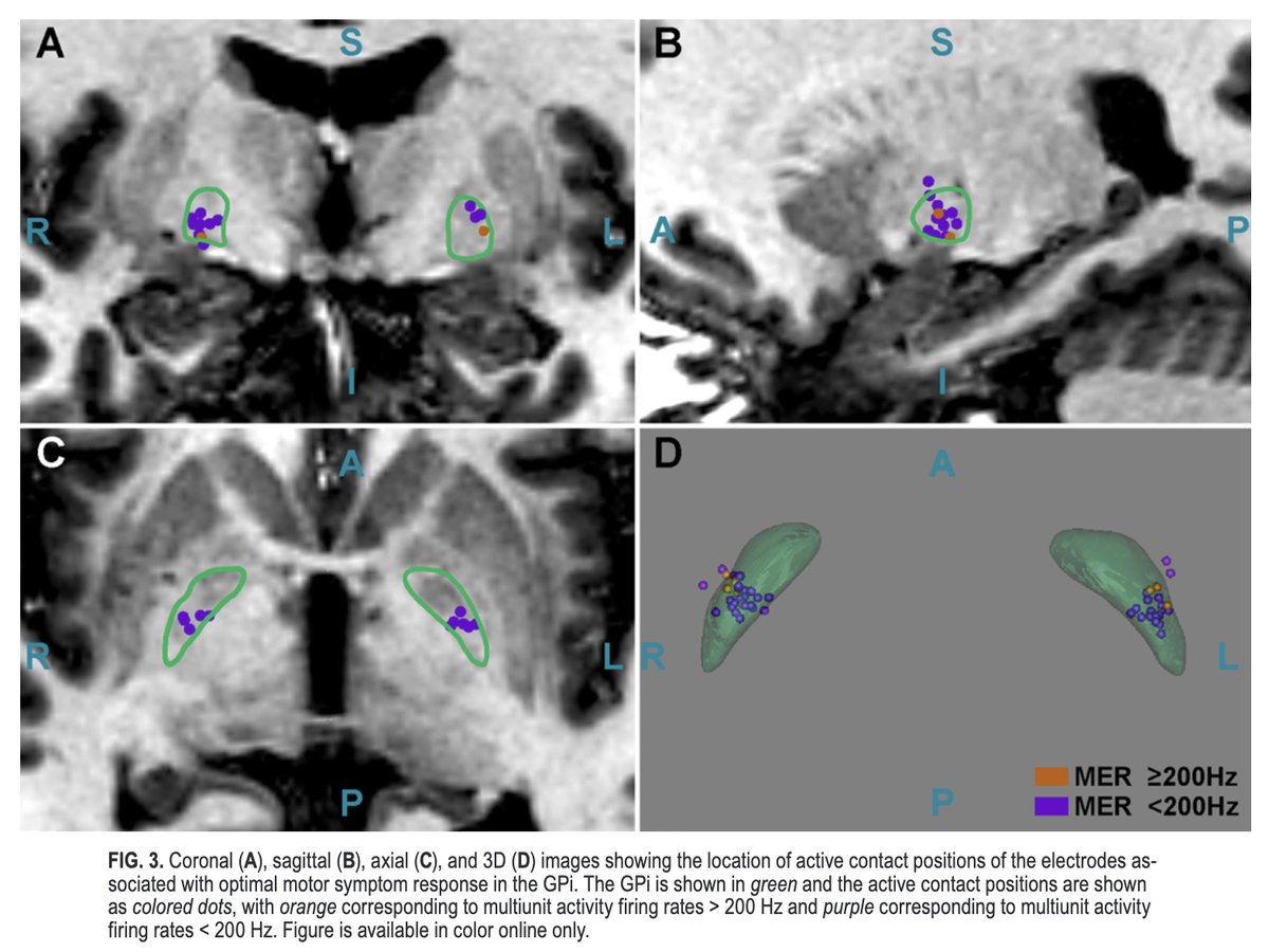 #OnlineFirst: Intraoperative neural firing correlates with motor and cognitive features in Parkinson’s disease.

thejns.org/view/journals/….