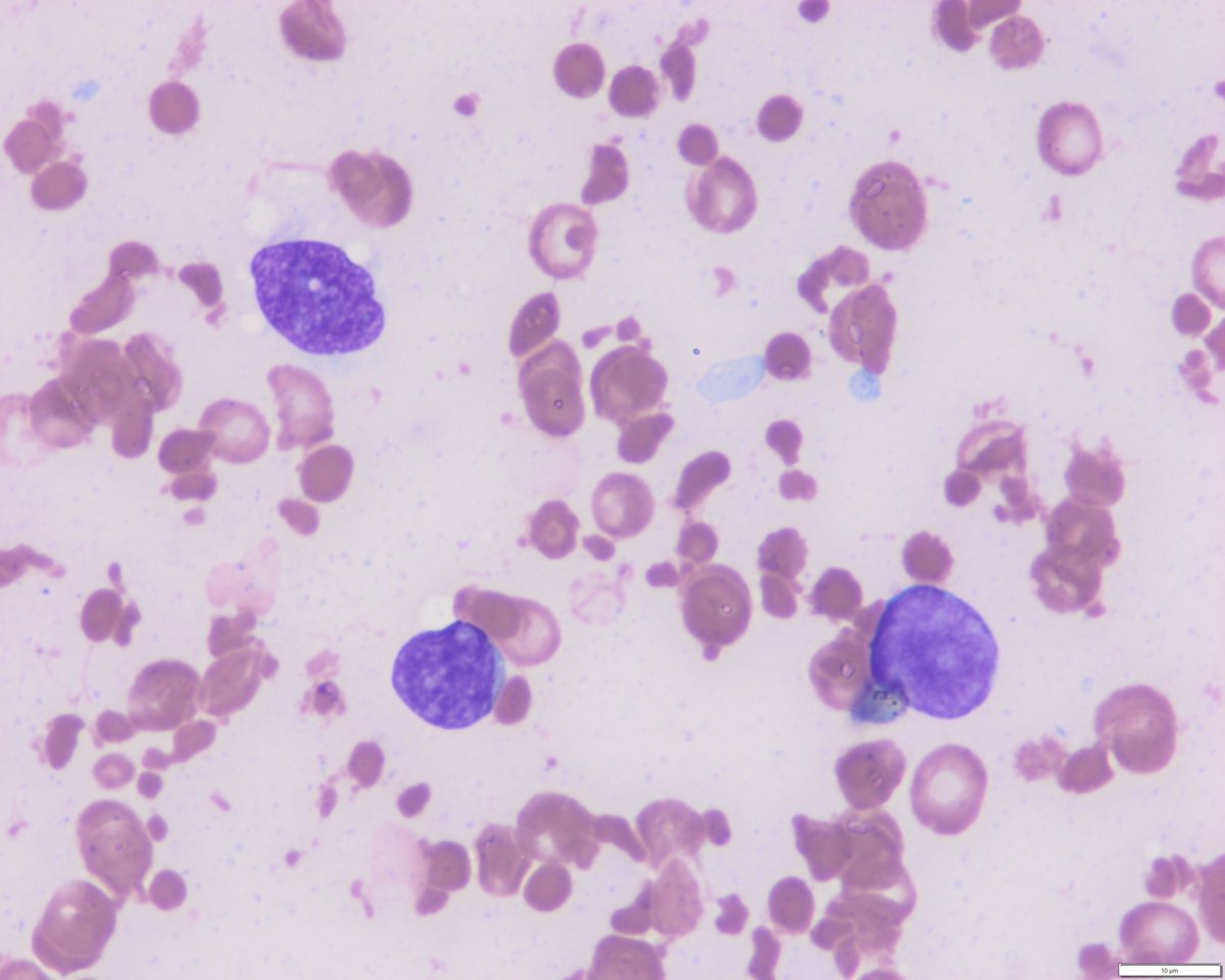 Interrupting your #ASCO25 feed with 3 👌🏼 #hemepath cases from last week’s sign-out 🔬 🧵 

1. R/R AML with unusual morphology, small primitive blasts, stromal fibrosis and marked proliferation of micromegakaryocytes (blue arrow head)