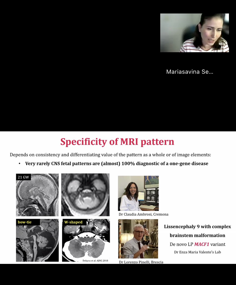 American Society of Pediatric Neuroradiology (@the_aspnr) on Twitter photo Still time to log in! ⏳
<a href="/MSavinaSeverino/">Mariasavina Severino</a> dives into genetic malformations and how to tell them apart from acquired fetal injuries.
What should we look for? Key imaging clues that make all the difference.
🔗 Join here: us02web.zoom.us/webinar/regist…
#IPNTN #PediNeuroRad #FetalMRI Still time to log in! ⏳
<a href="/MSavinaSeverino/">Mariasavina Severino</a> dives into genetic malformations and how to tell them apart from acquired fetal injuries.
What should we look for? Key imaging clues that make all the difference.
🔗 Join here: us02web.zoom.us/webinar/regist…
#IPNTN #PediNeuroRad #FetalMRI