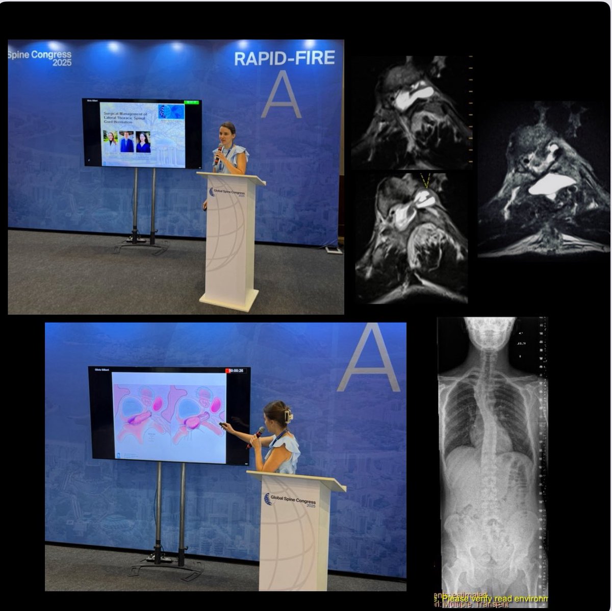 MGalganoMD's tweet image. Phenomenal talk by our @UNCneurosurgery resident, @oliviagil7 at #GSC2025 on scoliosis-associated lateral spinal cord herniation!
Incredible illustrations by our own, @BolesXian !
Stay tuned for an upcoming surgical video pub!
@GlobalSpineJ
@AOSpine
@UNC_Health_Care