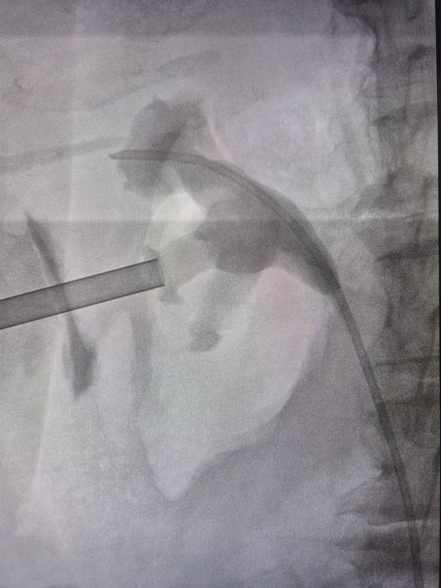 Marcos Cepeda (@drmarcoscepeda) on Twitter photo Workshop on supine #miniperc and #TFL at #HURH
- US & fluoroscopy puncture
- encrusted DJ
- miniECIRS
- obesity
Thanks to Coloplast <a href="/EspanaIu/">Coloplast IU España</a> for the support
Congrats to my team! <a href="/CoralManso/">Coral Manso Aparicio</a> Paula Arce
#teaching
#training Workshop on supine #miniperc and #TFL at #HURH
- US & fluoroscopy puncture
- encrusted DJ
- miniECIRS
- obesity
Thanks to Coloplast <a href="/EspanaIu/">Coloplast IU España</a> for the support
Congrats to my team! <a href="/CoralManso/">Coral Manso Aparicio</a> Paula Arce
#teaching
#training