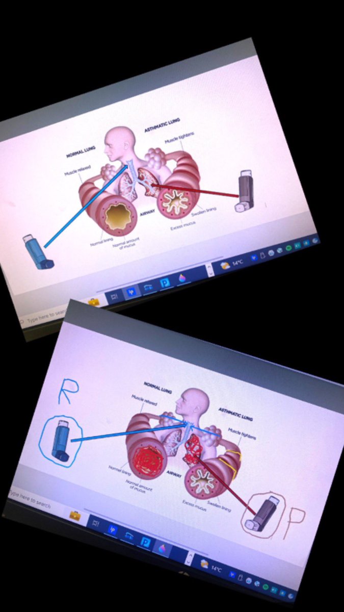 Some virtual visuals for patients that have video asthma consultations today. This pic is really helpful for explaining what happens during an asthma attack and the role of reliever and preventer inhalers ✨🫁💙