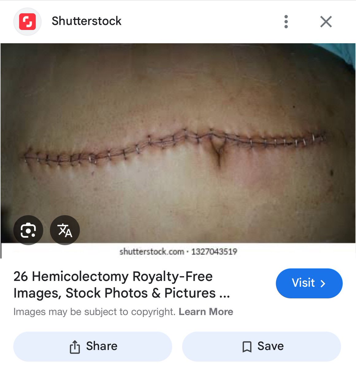 Laparoscopic Vs Open Colon cancer surgery. Image one is an incision of a patient we performed major oncological (cancer) surgery on 2 weeks ago. Image 2 is a standard open surgery incision for colon surgery. Can you spot the wound in image 1?