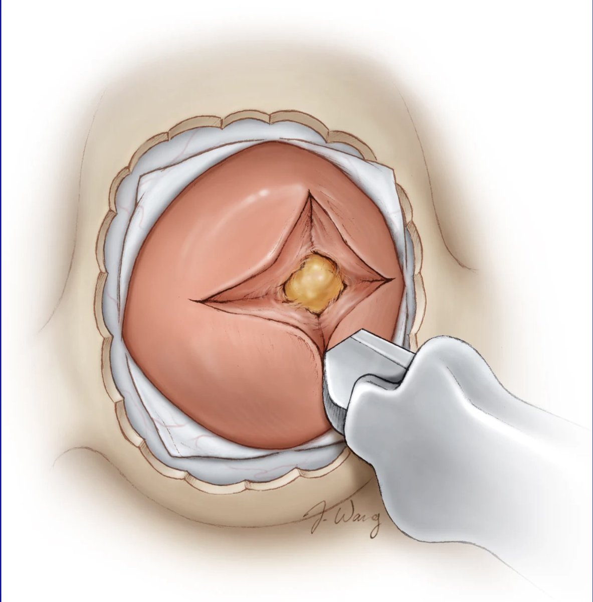 After making a cruciate incision like the one shown here to expose the pituitary gland, what are the key intraoperative features that help distinguish a microadenoma from normal gland tissue? 

#Neurosurgery #EndoscopicSurgery #PituitaryTumor #Neuroanatomy
