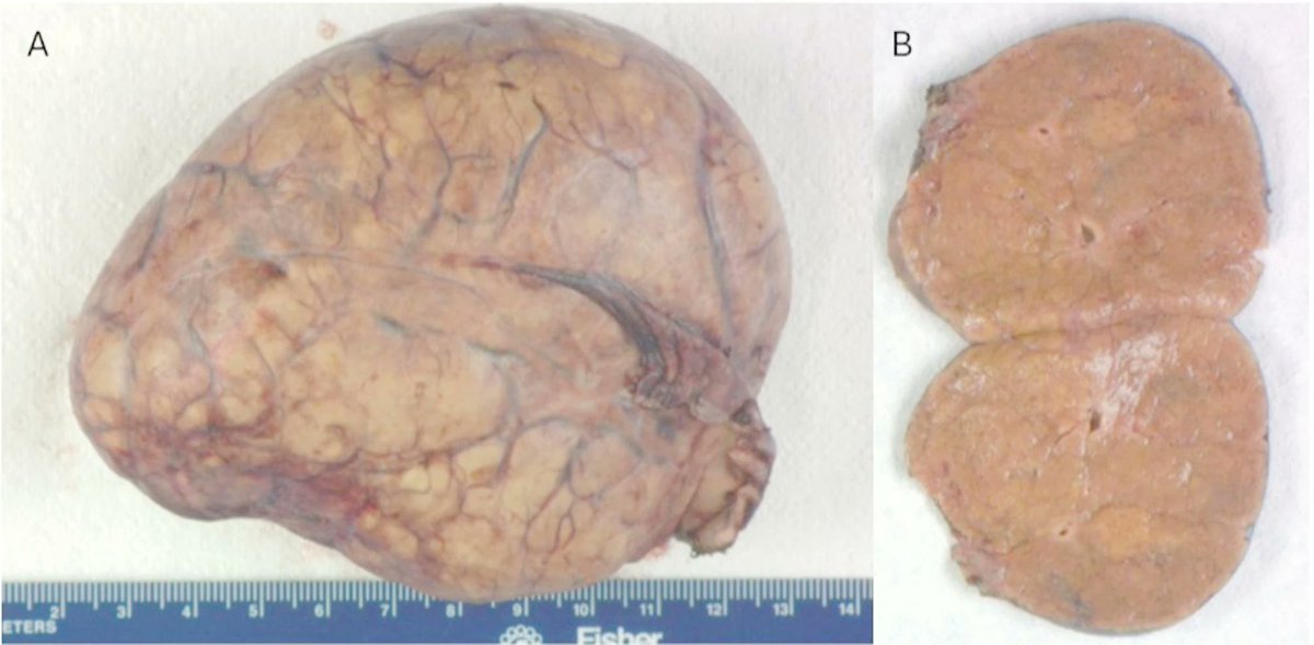 JGosnell2's tweet image. Take a look at our new article in @SpringerPath detailing a unique case of a pedunculated focal nodular hyperplasia! Special thanks to first author Dr. Taylor Strange.
#UTMBSIR @UTMB_Pathology @HLStevensonLab
diagnosticpathology.biomedcentral.com/articles/10.11…