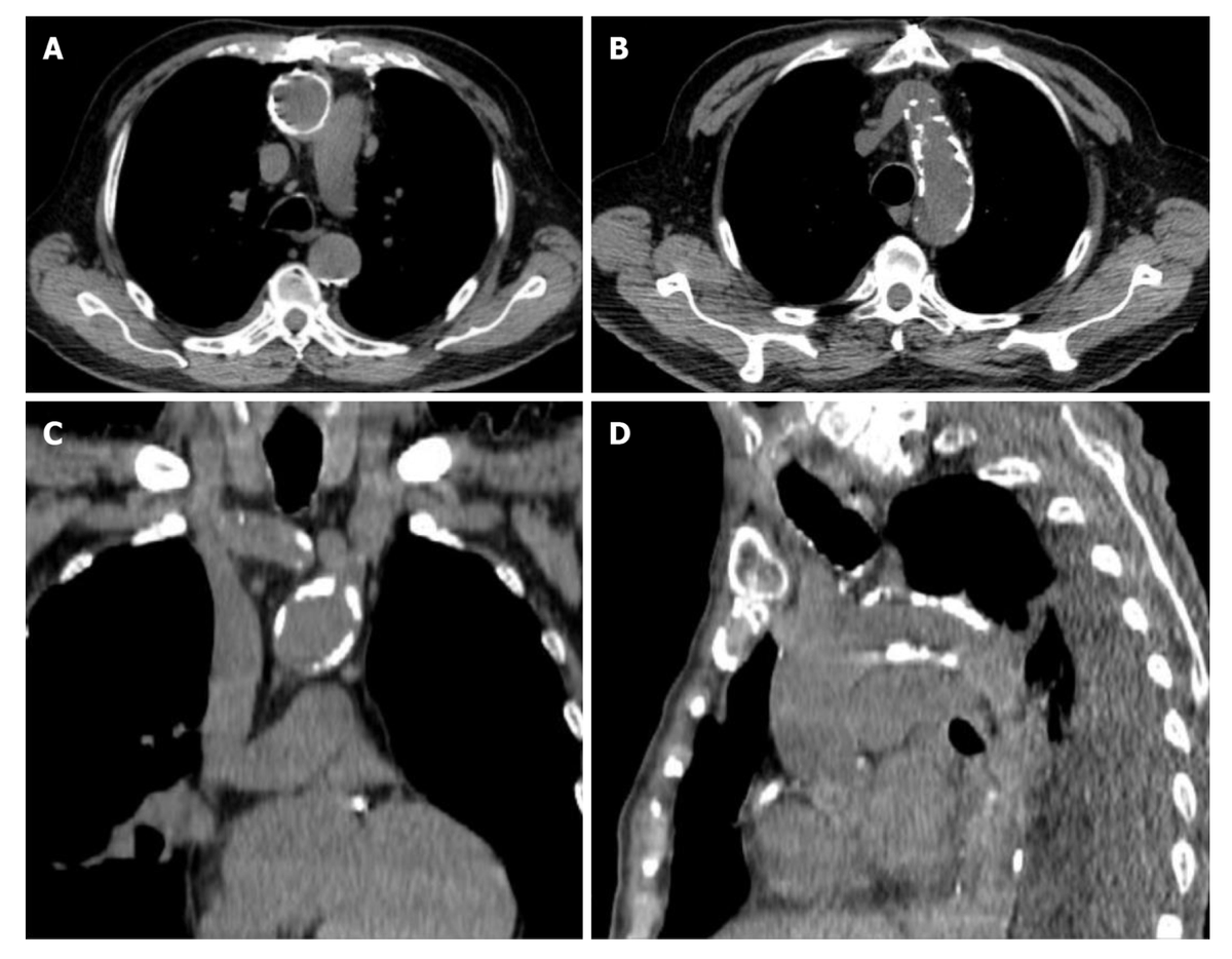 🔄 The aorta: the Achilles’ heel of coronary surgery.
🛑 Is OPCAB and no-touch enough? New strategies to reduce neurologic complications.
📌 Review published in #JTCVS
🔗 pmc.ncbi.nlm.nih.gov/articles/pmid/…
📝 Commentary at SECCE:
🔗 secce.es/en/management-…
#Aorta #StrokeRisk #SECCE #JTCVS