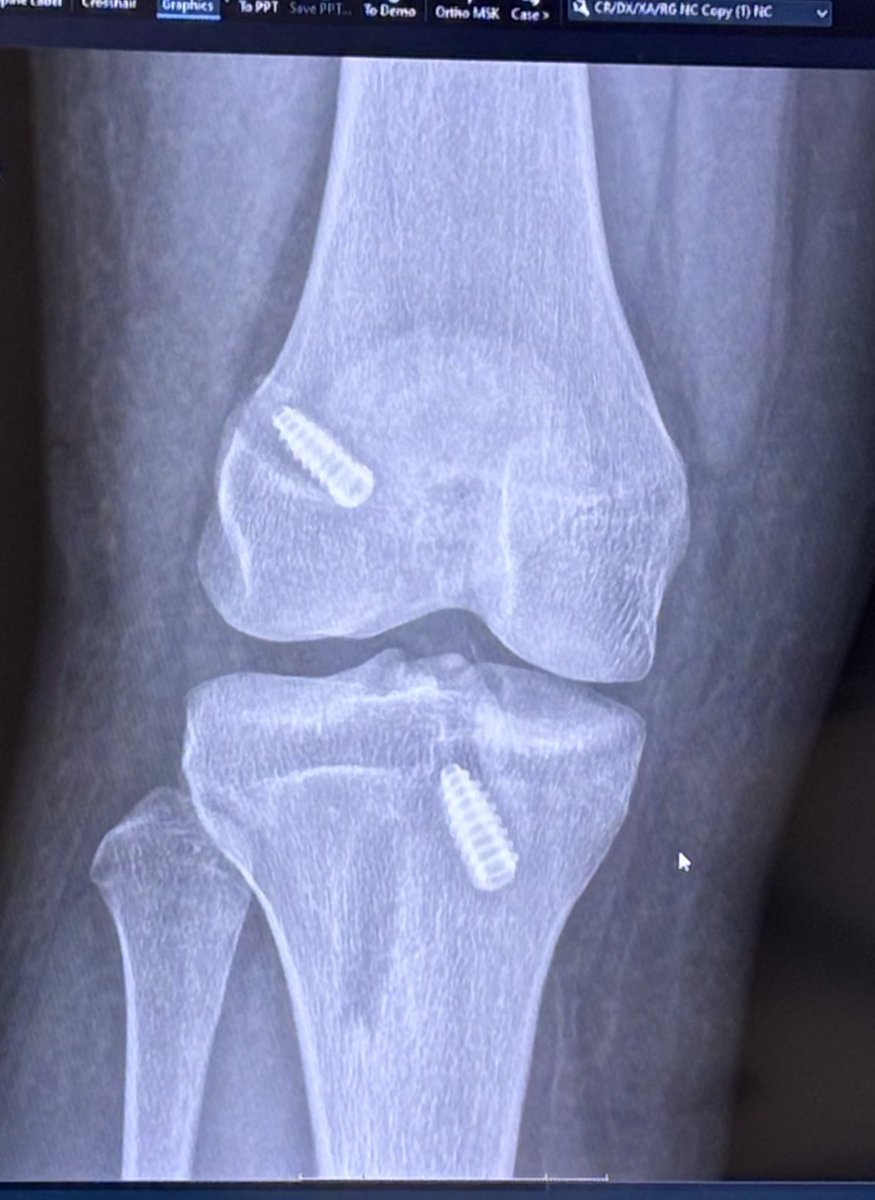 Addysen Cox (@addysencox09) on Twitter photo I’m two weeks post op from a successful ACL and meniscus surgery, and the road to recovery has started! In the meantime, I’ll be cheering on my <a href="/Texans09gECNL/">Dallas Texans 09G ECNL</a> team every chance I get, and counting down the days until I’m back on the field! Trusting in Gods plan! 🤍 I’m two weeks post op from a successful ACL and meniscus surgery, and the road to recovery has started! In the meantime, I’ll be cheering on my <a href="/Texans09gECNL/">Dallas Texans 09G ECNL</a> team every chance I get, and counting down the days until I’m back on the field! Trusting in Gods plan! 🤍