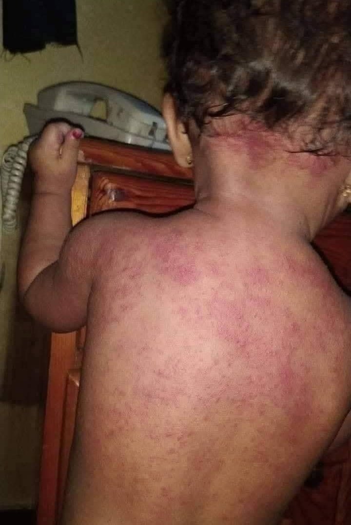 ما ذنب هذا الطفل يا مسؤوليين اليمن المحترمين؟؟؟؟

أطفالكم لايعأنون مثل معاناة أطفالنا لأن برود المكيفات لاتنقطع من على أجسامهم ولا يتألمون من الألم الحر و الحرارة و من الحبوب الذي على أجسامهم 

إلى الله المشتكى فيكم جميعاً💔