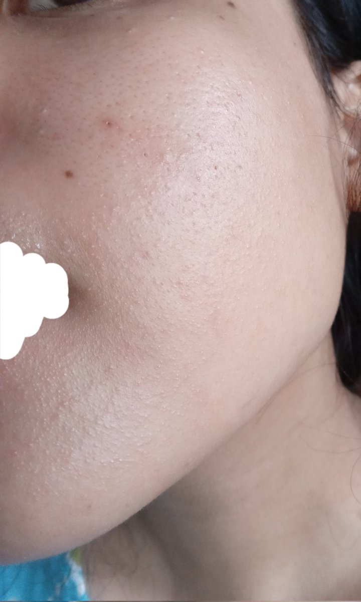 usedbyber's tweet photo. TW ⚠️ bintik bintik, trypophobia

baru pertama kali kyak gini, cara ngatasinnya gimana tolong😭😭 https://t.co/z9zKC1fSRM