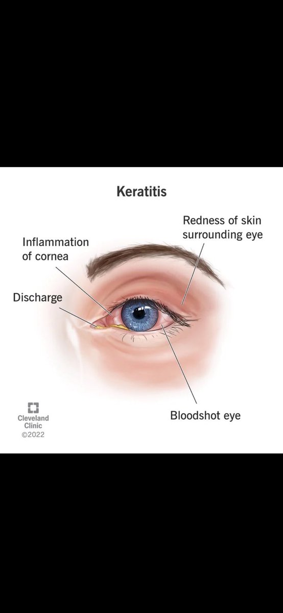3obad_198's tweet image. keratitis 
One of the most common side effect of using Cytarabine” AR-c 
For hematological malignancy , Hight tumor burden 
“Eyes drop is necessary for managing this revers effect 
#oncology 
#studywithme 
#Hematology