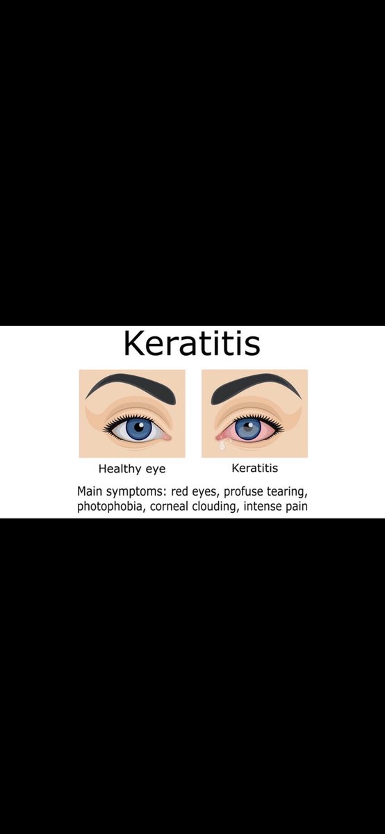 3obad_198's tweet image. keratitis 
One of the most common side effect of using Cytarabine” AR-c 
For hematological malignancy , Hight tumor burden 
“Eyes drop is necessary for managing this revers effect 
#oncology 
#studywithme 
#Hematology
