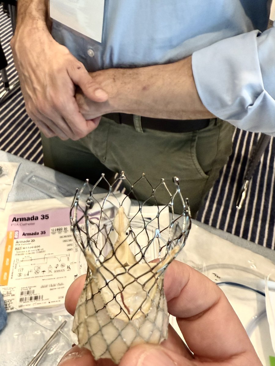 Ahmed Ghoneem, MD MSc (@a_h_ghoneem) on Twitter photo Incredible day at <a href="/OPCILive/">OPCI</a>’s electrosurgery workshop today, “co-scrubbing” for BASILICA & BA-BASILICA with the 👑 <a href="/AhmadJabri8/">Ahmad Jabri MD , FACC, FSCAI</a>
Thank you <a href="/PaulMahoneyMD/">Paul Mahoney</a> <a href="/ignamatsant/">Ignacio J. Amat</a> <a href="/AndreaScotti21/">Andrea Scotti</a> <a href="/CathElectroSurg/">Jaffar Khan</a> <a href="/AdamGreenbaumMD/">Adam Greenbaum</a> for the state of the art, hands-on teaching! Incredible day at <a href="/OPCILive/">OPCI</a>’s electrosurgery workshop today, “co-scrubbing” for BASILICA & BA-BASILICA with the 👑 <a href="/AhmadJabri8/">Ahmad Jabri MD , FACC, FSCAI</a>
Thank you <a href="/PaulMahoneyMD/">Paul Mahoney</a> <a href="/ignamatsant/">Ignacio J. Amat</a> <a href="/AndreaScotti21/">Andrea Scotti</a> <a href="/CathElectroSurg/">Jaffar Khan</a> <a href="/AdamGreenbaumMD/">Adam Greenbaum</a> for the state of the art, hands-on teaching!