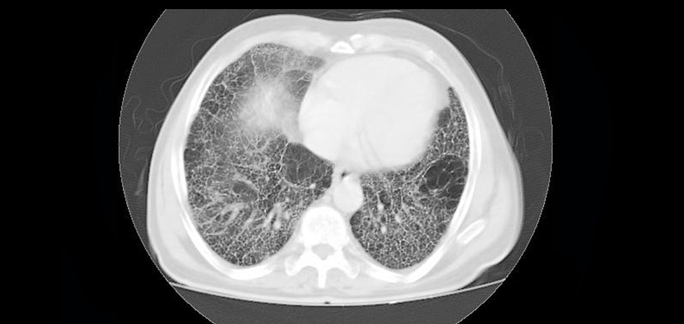 A molecular variant of an older, hard-to-tolerate antifibrotic agent showed promise for reducing decline in forced vital capacity (FVC) over 26 weeks among patients with idiopathic pulmonary fibrosis (IPF). ms.spr.ly/6016SiGCs